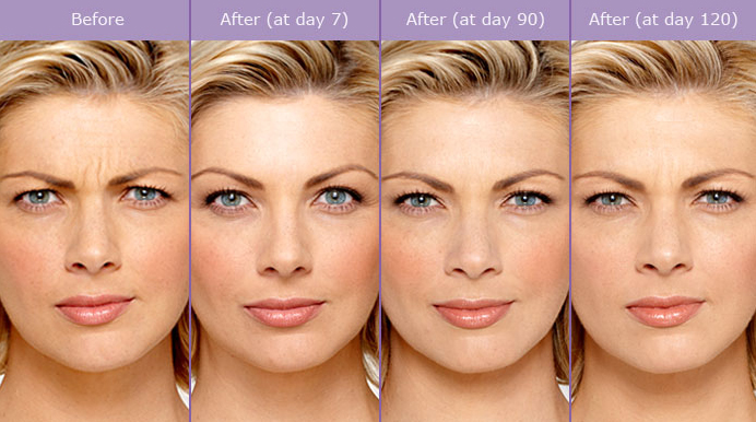 Botox Alternatives